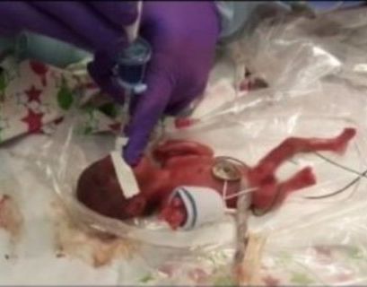 Самую маленькую новорожденную в мире выписали из больницы в США